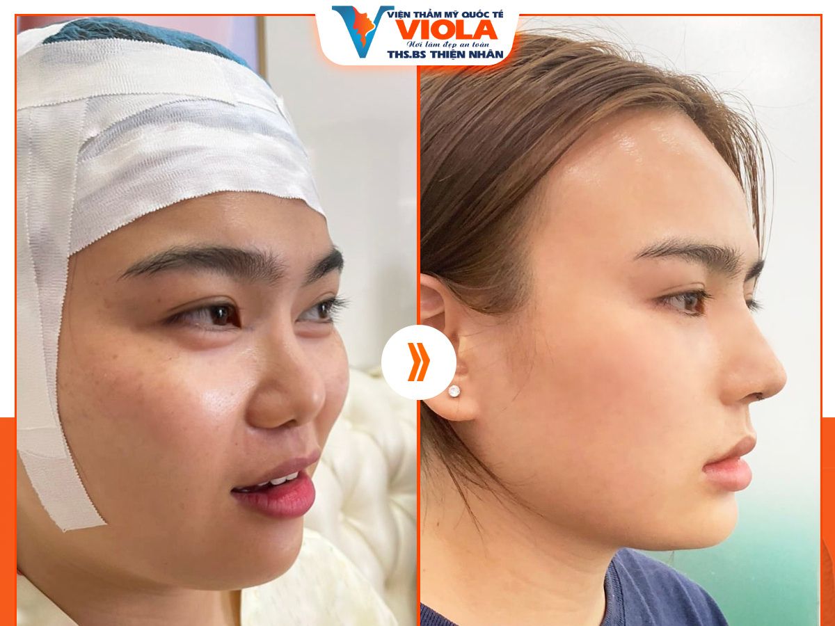 Hình ảnh trước và sau khi nâng mũi